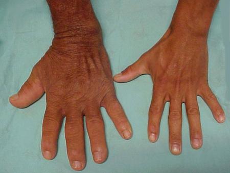 ACROMEGALY – Causes, Clinical Manifestation, Diagnostic Evaluations Management and Medication
