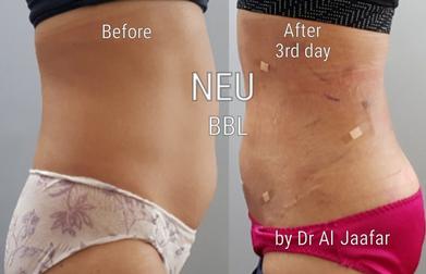 Brazilian butt lift (BBL) before and after photos