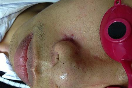 sutures are removed with minimal scarring