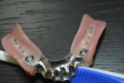 PARTIAL DENTURE ON IMPLANTS "CLICK" Michel Puertas Denturologiste Brossard-Laprairie