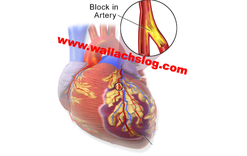 Heart Artery Obstruction - Dr. Joel Wallach