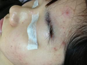 手術脫墨後的傷口隱藏在眉毛的毛髮裡面，肉眼幾乎看不見