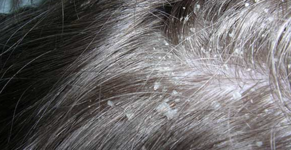 Chronic Dandruff - Dr. Joel Wallach