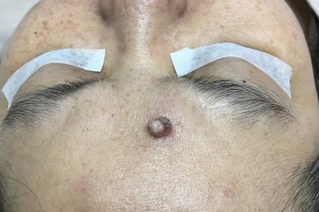 額頭皮膚疣 forehead skin wart