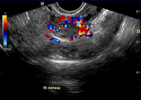 ectopic pregnancy treatment goa