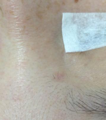 幾個星期後再觀察疤痕情況，疤痕幾乎看不見