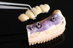 pont dentaire sur implants dentaire Brossard-Laprairie