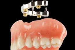 Prothèse Dentaire Sur Implants Avec Barre Michel Puertas Denturologiste Brossard-Laprairie, Denture On Implants With Bar Michel Puertas Denturologiste Brossard-Laprairie