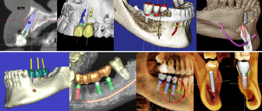 Scan 3D Clinique Implantologie Dentaire Brossard