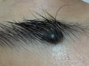 a large black naevus terminal hair growth locates inside the medial end of the right eyebrow.