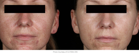 Cosmetic Injectables Center, Encino, Sherman Oaks Botox, Fillers, Restylane, Juvaderm, skin, redness, pigmentation, veins