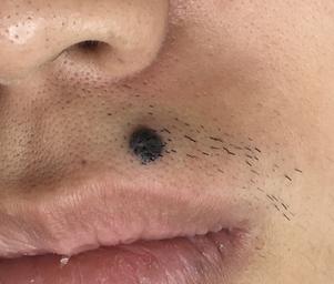 a black flat mole situated on left upper cutaneous lip