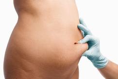 5 things about liposuction