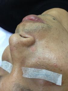 脫墨後立即看到的傷口情況，沒有流血，幾乎看不見疤痕