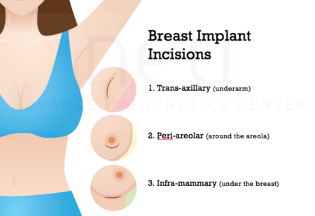 Breast implant incisions