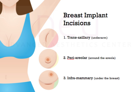 How Much Is Breast Implants In The Philippines