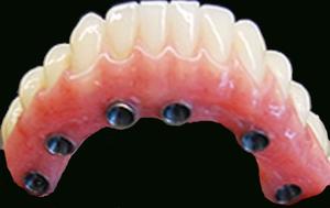 Fixed Denture On Implants Michel Puertas Denturologiste Brossard-Laprairie