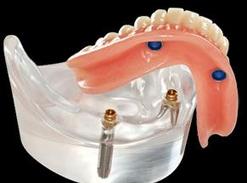 Denture On Implants Michel Puertas Denturologiste Brossard-Laprairie