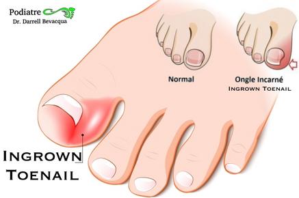 Ingrown Nail From a Fat Toe 