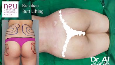 Brazilian Butt Lift (BBL) Safety Update - Basu Aesthetics