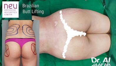 Brazilian butt lift (BBL) before and after photos