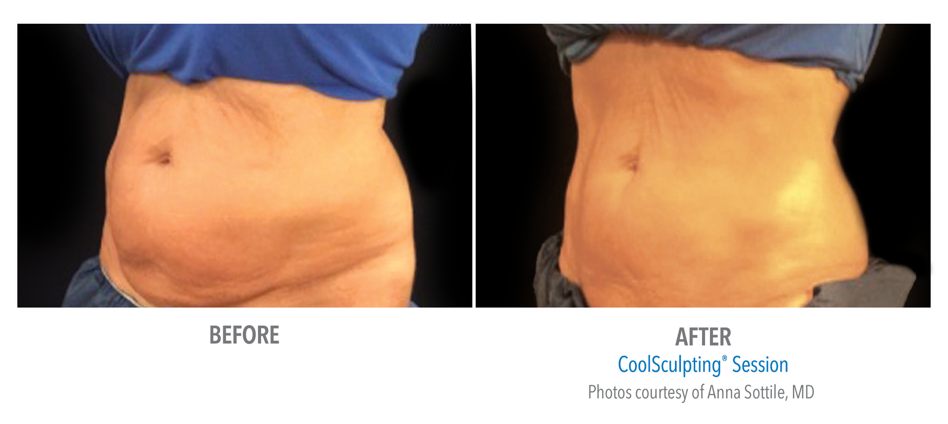 The Aesthetic Ine Institute Of Miami Offers Coolsculpting For Women And Men Who Exercise Eat Right But Still Can T Shed Stubborn Fat That