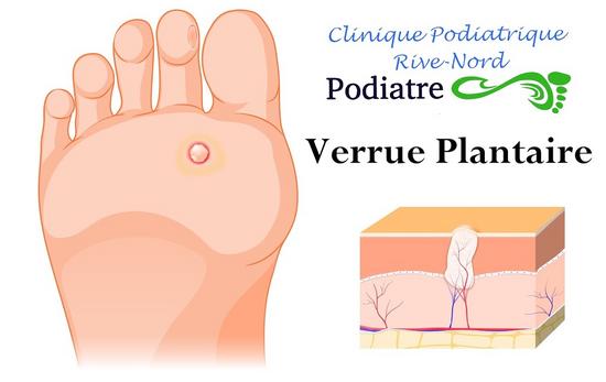 Verrue plantaire - Clinique Podiatrique DIX30