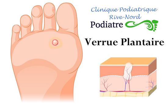 Verrue plantaire  Clinique podiatrique