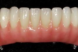 Fixed Denture Fix-On-Zircon Brossard-Laprairie