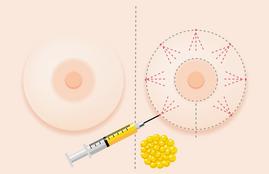 Breast fat grafting transfer Philippines