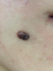 近鏡：位於右邊下巴的深啡色墨痣