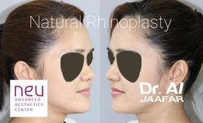 Rhinoplasty before and after photos