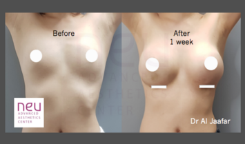 Breast implants before and after photos