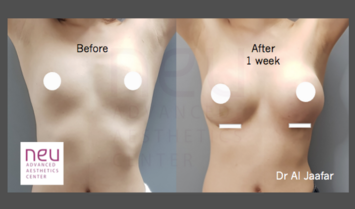 Top breast implant augmentation clinic in the Philippines NEU