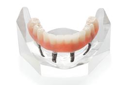 Prothèse Dentaire Sur Implants Fixe Fix-On-4 Brossard-Laprairie
