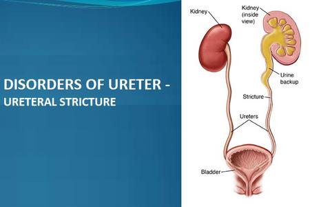 DISORDERS OF URETER – Causes and Risk Factors, Classification, Pathophysiology, Clinical Manifestations, Diagnostic Evaluations and Management - URETERAL STRICTURE