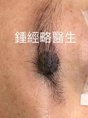 a big, protruding, black mole situated inside the left eyebrow