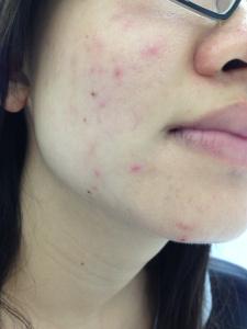 術後２個月疤痕情況