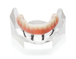 Denture On Implants Fix-On-4 Clinique Implantologie Dentaire