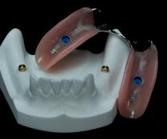 PARTIAL DENTURE ON IMPLANTS "CLICK" Michel Puertas Denturologiste Brossard-Laprairie