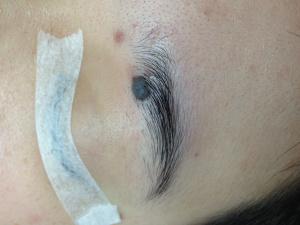a black skin mole situates near eyebrow
