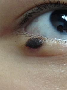 a black raised skin mole located on the lower eyelid near the eyelid margin