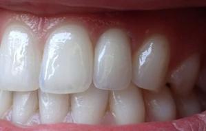 Fixed Denture On Implants Michel Puertas Denturologiste Brossard-Laprairie