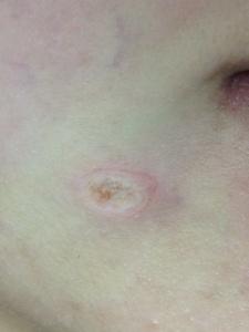 激光脫墨手術後的傷口：一個下陷的，沒有流血，根部完全清除的傷口