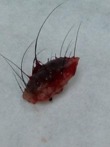 a hairy excised skin mole