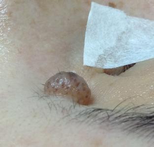 近鏡觀察一粒位於眉毛下方，近鼻樑位置的，淺啡色的， 凸出皮膚表面的墨痣