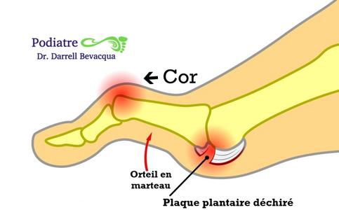 Coussinets plantaires  Eliminent les durillons