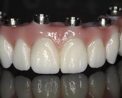 Prothèse Dentaire Fixe Zircon Sur Implants Michel Puertas Denturologiste Brossard-Laprairie, Fixed Denture On Implants Michel Puertas Denturologiste Brossard-Laprairie