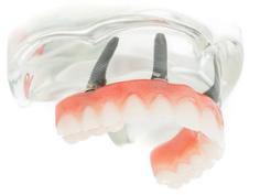 Prothèse Sur Implants Fix-On-4 Clinique Implantologie Dentaire