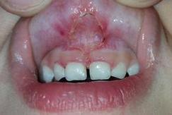 labial frenulum